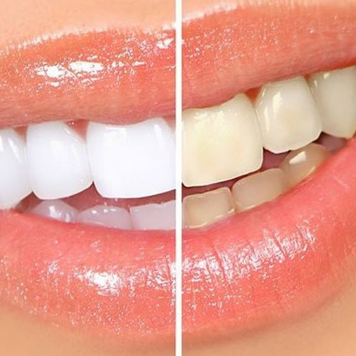 Tratamiento de blanqueamiento dental