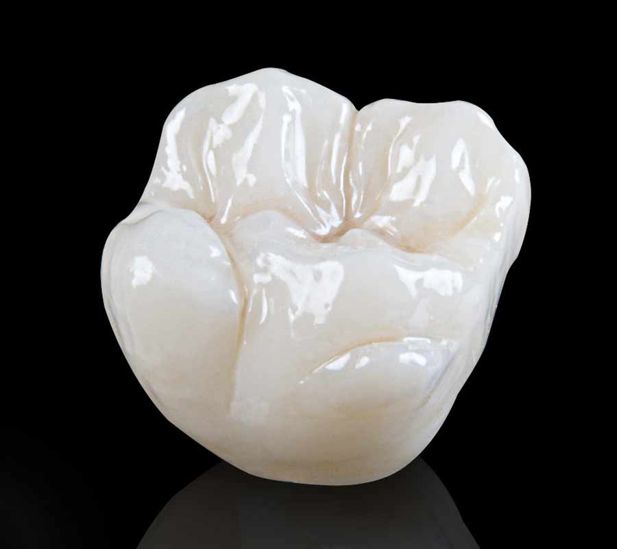 Corona dental sin metal