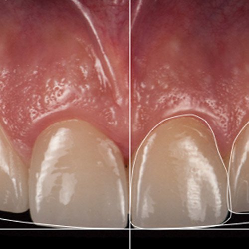 Tratamiento de ortodoncia invisible