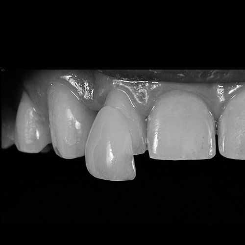 Tratamiento de carillas dentales