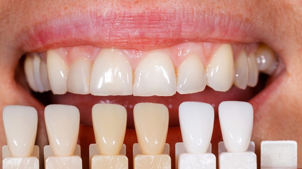 Fotografía de estética dental relacionada con el blanqueamiento