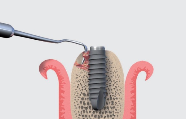 Fotografía sobre el mantenimiento de implantes dentales