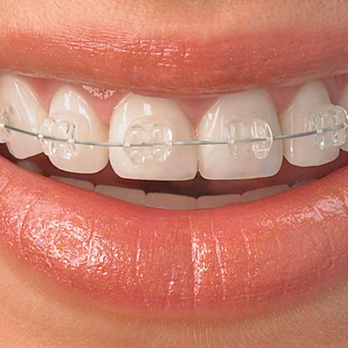 Tratamiento de brackets estéticos