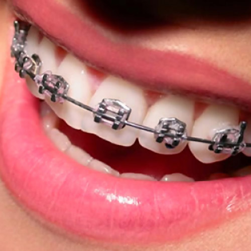 Tratamiento de brackets metálicos