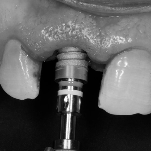 Tratamiento de implantes postextracción