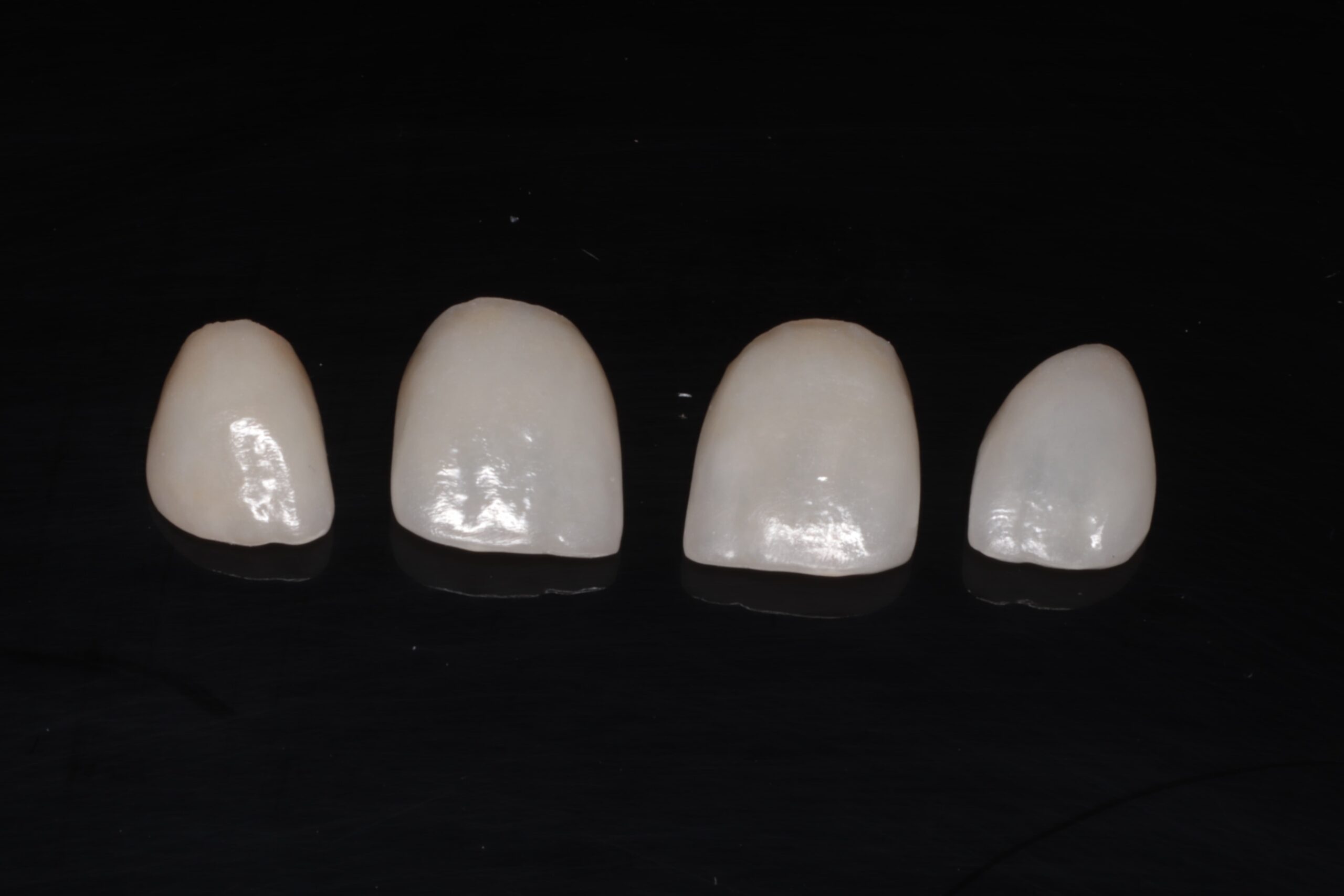 Fotografía clínica sobre carillas dentales