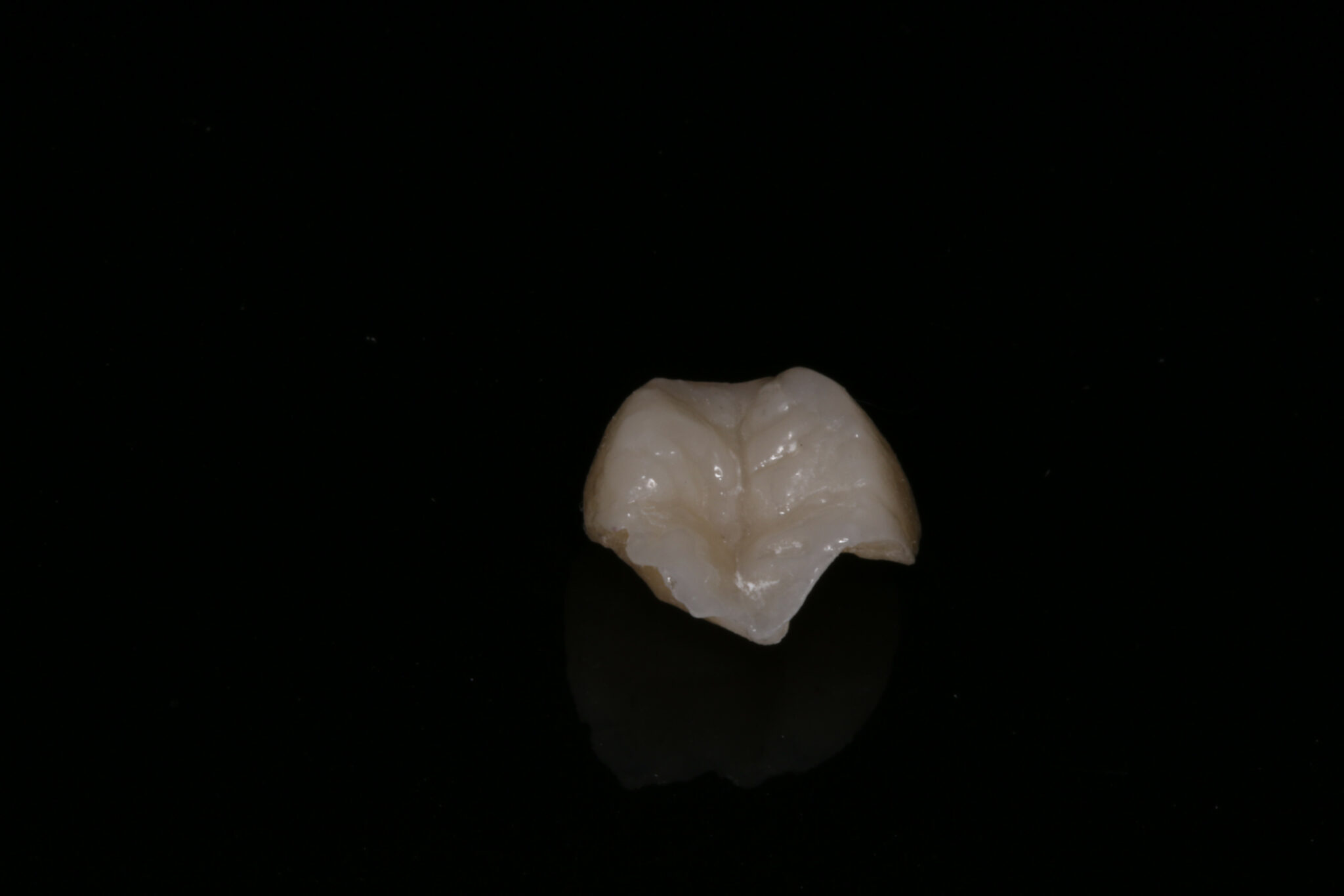 Fotografía clínica sobre incrustaciones dentales