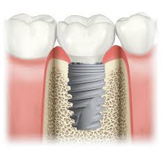 Implante dental