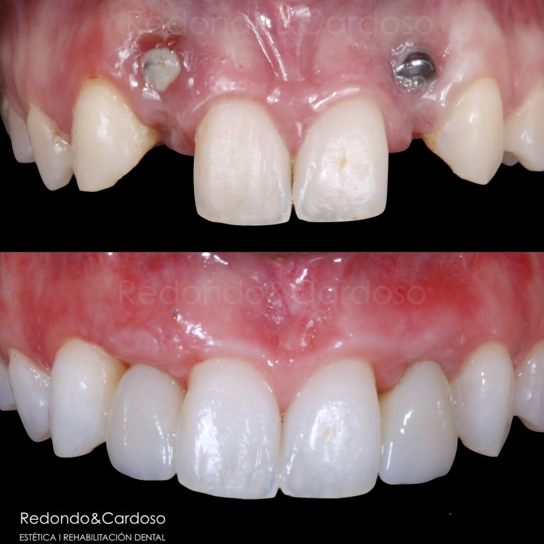Caso clínico de retratamiento de implantes, imagen 2 de 2