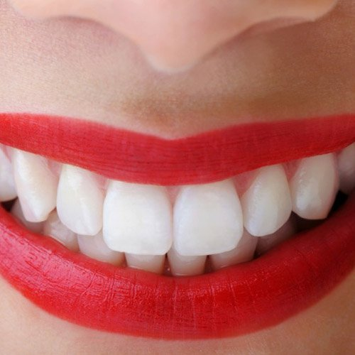 Fotografía de estética dental
