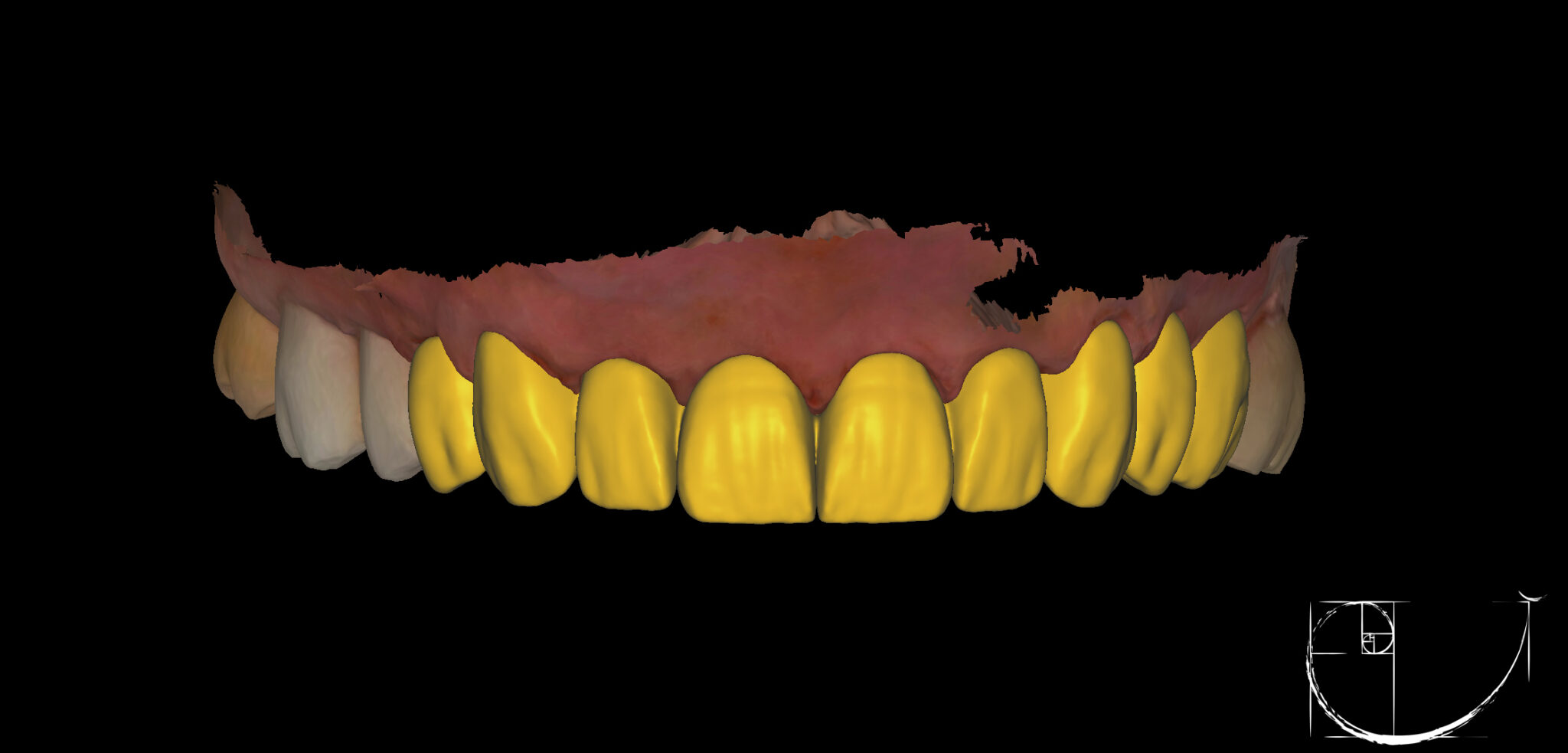 Planificación digital de un diseño de sonrisa