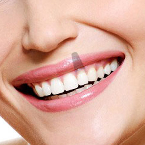¿Que son los Implantes Dentales?
